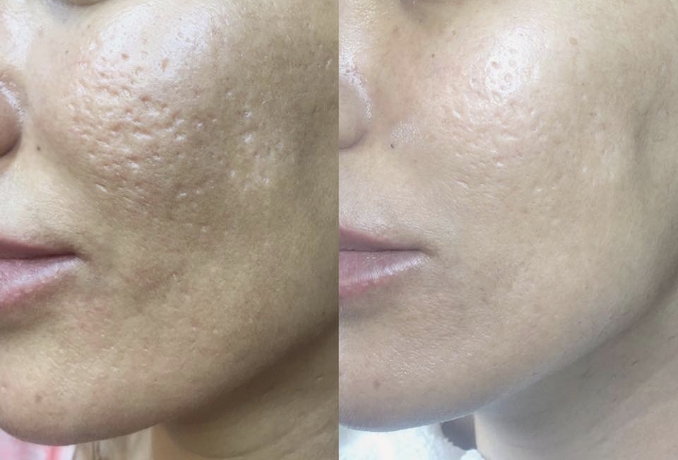 before and after microneedling