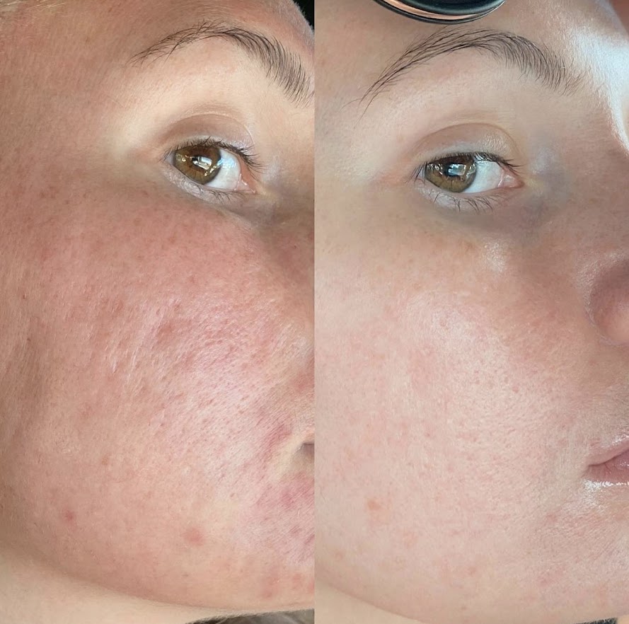 microneedling Vancouver