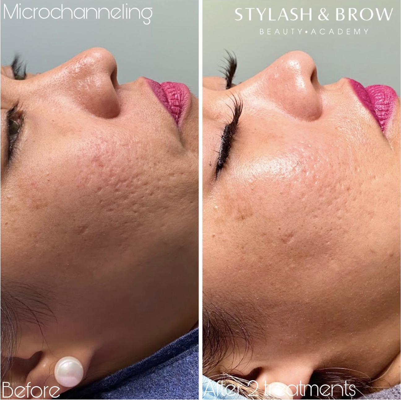 microneedling vancouver client