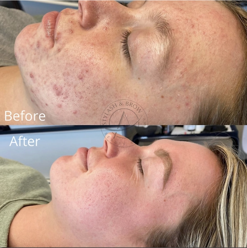 microneedling for acne scars