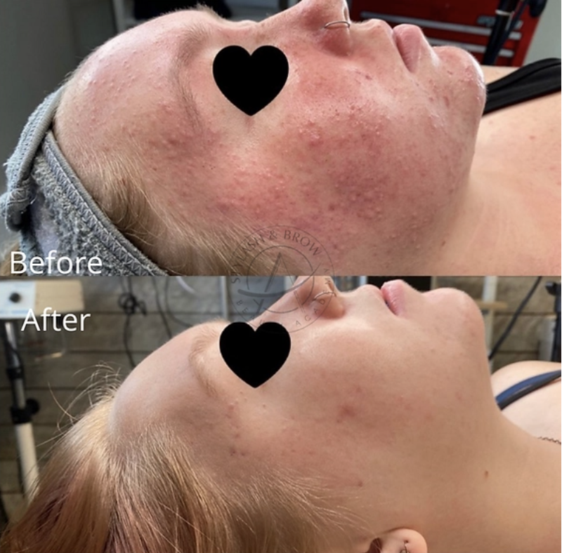 microneedling for acne scars
