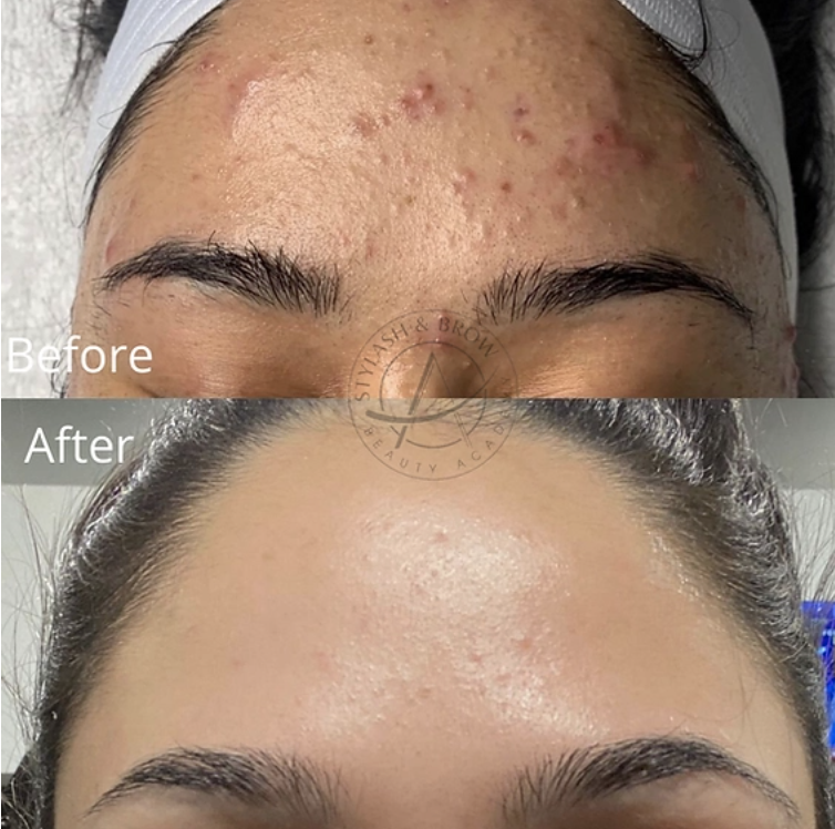 microneedling for acne scars