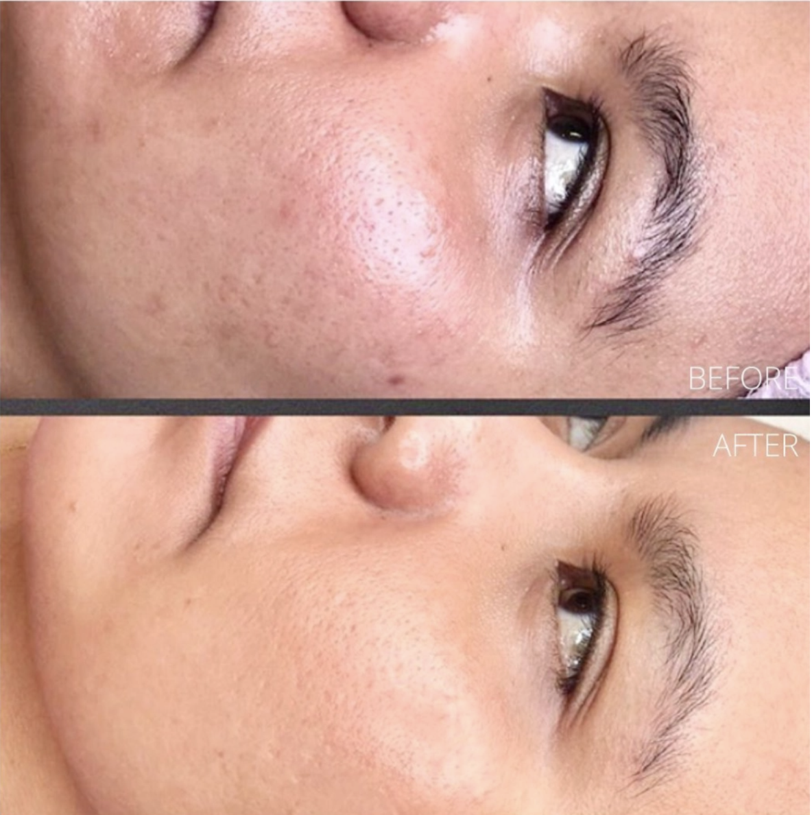 microneedling for pores